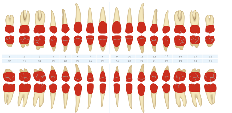 Permanent Crown