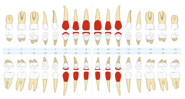 Veneer