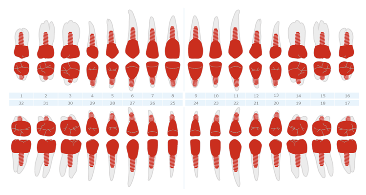 Implant Crown